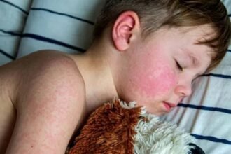 Dangerous measles virus found in California sewage