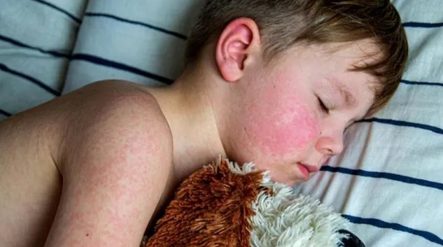 Dangerous measles virus found in California sewage